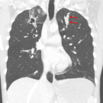 Red arrows: finger-in-glove appearance of mucous filling dilated bronchi on this patient's subsequent CT.