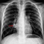 Red arrow: medial right lung opacity with a somewhat tubular configuration.