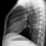 Red arrow: corresponding opacity in the superior segment of the right lower lobe on the lateral view.