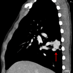 Red arrow: tangle of vessels demonstrated on the subsequent chest CT consistent with AVM.
