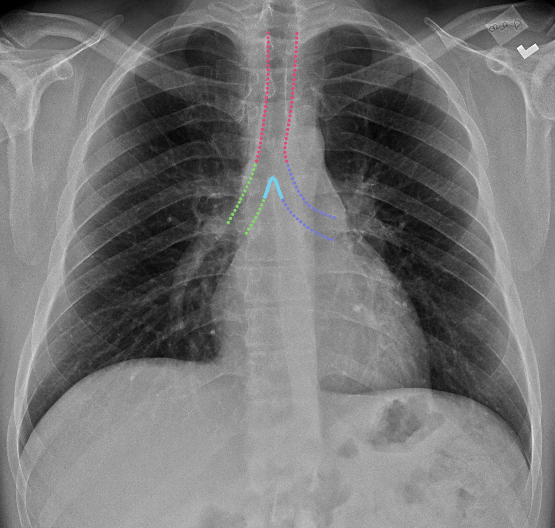 CaseStacks.com - Chest X-Ray Anatomy for Medical Students
