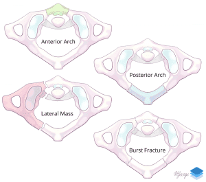 Fractures of the atlas.