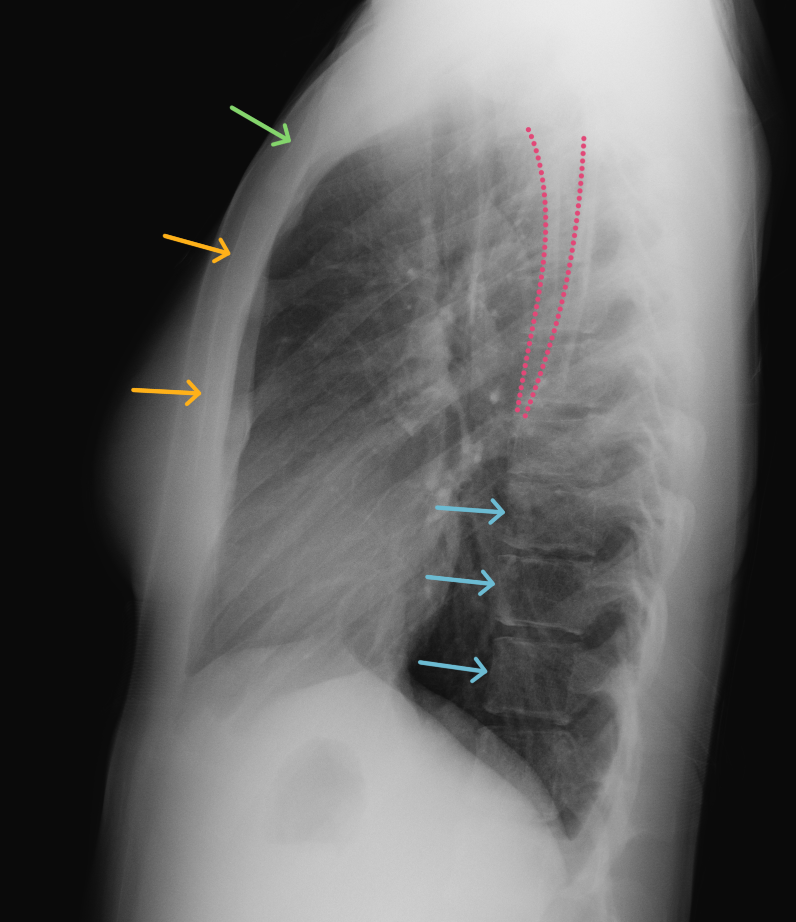CaseStacks.com - Chest X-Ray Anatomy for Medical Students