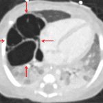 Red arrows: macrocystic mass confirmed on subsequent chest CT.