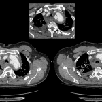 Subsequent CT demonstrated an aortic intimal tear.