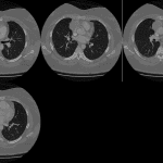 Subsequent CT shows an anterior mediastinal mass most consistent with a thymoma.