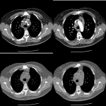 Subsequent CT shows extensive mediastinal and hilar adenopathy, including right paratracheal adenopathy.