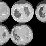 CT scan of this patient showing typical findings of asbestosis related pulmonary fibrosis
