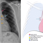 In comparison, this normal radiograph & illustration demonstrate normal heart borders & vessel interfaces.
