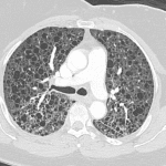 This patient's chest CT showing numerous bilateral thin-walled cysts.