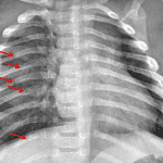 Red arrows: acute right and subacute left rib fractures in a distribution concerning for child abuse.