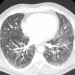 Followup chest CT in this patient shows bilateral lower lobe predominant subpleural reticulation and groundglass opacification without honeycombing, most characteristic of NSIP.