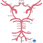 PICA aneurysm.