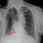 Red arrows: right lower lobe collapse.