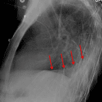 Red arrows: right lower lobe collapse.