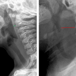 Comparison normal on the left and patient with retropharyngeal abscess on the right. Note the marked retropharyngeal soft tissue thickening in the patient on the right indicated by the red line.