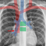 Superior cavoatrial junction (red arrow) is defined by the point where the SVC crosses the bronchus intermedius, and is well approximated by counting 2 vertebral body heights below the carina