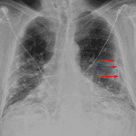 Calcified pleural plaques (red arrows).