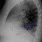 Blue arrows: right lower lobe collapse.