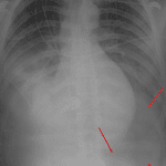 The left costophrenic angle is abnormally deepened when pleural air collects at the chest base (red arrows), producing the deep sulcus sign.