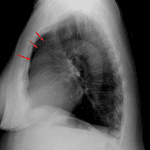 The ascending aortic aneurysm is also apparent on the lateral projection (red arrows).