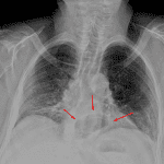 Gas filled hiatal hernia (red arrows).