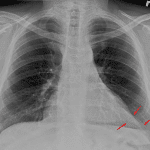 Hazy soft tissue density along the inferior left heart border (red arrows).