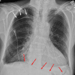 Pneumomediastinum with continuous diaphragm sign (red arrows). Moderate right apical pneumothorax (white arrows).