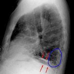 Calcified pleural plaques (red arrows) and lower lung predominant fibrosis (blue circle)