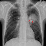 Rounded opacity centered in the superior aspect of the left lower lobe with an air crescent (red arrows).