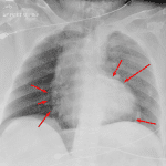 Pneumopericardium (red arrows).