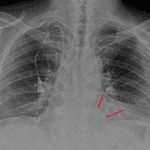 Rounded opacity in the medial left lung base consistent with a hiatal or paraesophageal hernia.
