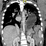 CT confirmed diaphragmatic rupture.