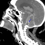 Blue arrow: left PICA aneurysm.