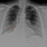 Red arrows: right lower lobe collapse. Obscuring of the right heart border also indicates right middle lobe collapse.