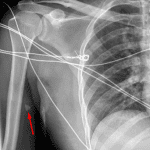 Triangular radiopaque foreign body (likely glass) in the soft tissues of the upper right arm (red arrow).