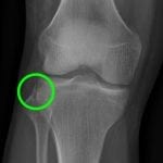 Green circle: Segond fracture