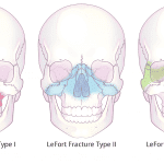 LeFort Fracture Classification