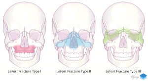 LeFort Fracture Classification