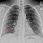 Approximately 4 cm mass in the mediastinum (red arrows) adjacent to the right heart border.