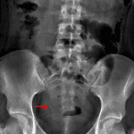 Red arrow: calcification overlying the expected location of the right UVJ.