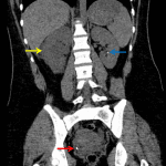 Subsequent noncontrast CT in this patient confirms the right UVJ stone (red arrow) and additionally shows right hydronephrosis (yellow arrow) and a small nonobstructing left renal stone (blue arrow).