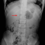 Red arrow: irregular calcification in the region of the right adrenal gland.