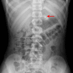 Red arrow: irregular calcification overlying the expected location of the left adrenal gland.