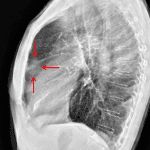 Nodular density projecting in the anterior mediastinum on the lateral projection.