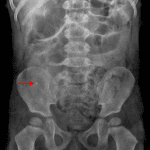 Red arrow: calcification overlying the right iliac bone.
