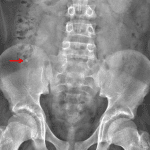 Red arrow: calcific density overlying the right iliac bone, which may represent an appendicolith.