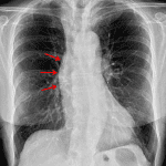 Bulging of the aortic contour to the right (red arrows).