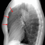 Bulging of the aortic contour anteriorly (red arrows).