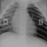 Asymmetric hyperinflation of the left lung.